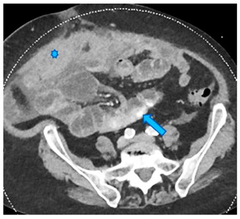 Unravelling Peritoneal Carcinomatosis Using Cross-Sectional Imaging ...