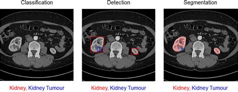 Computer Vision for Tumour 的图像结果