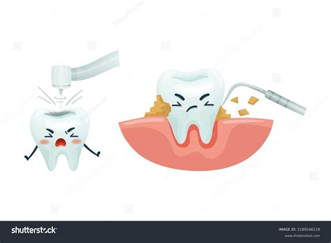 Image result for Tooth Calculus