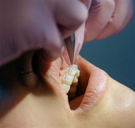 Image result for Abscessed Tooth Explosion