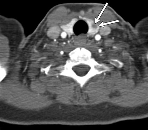 Thymic Nodule Ct at Ross Brown blog