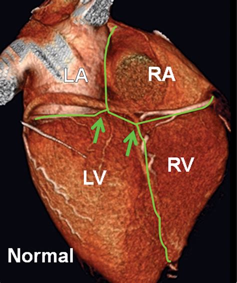 Septal Atrioventricular Junction Region: Comprehensive Imaging in ...