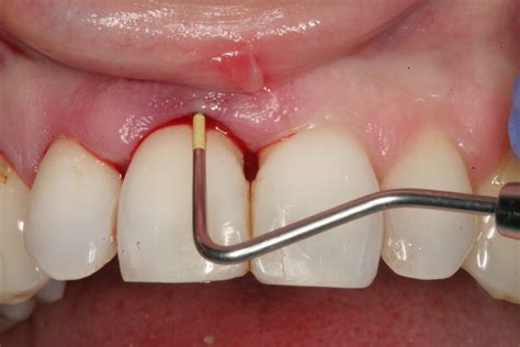 Abscessed Teeth – Perio Peak