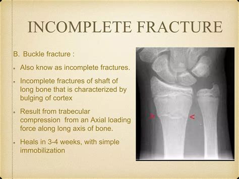 Fractures, types and lower extremities | PPTX