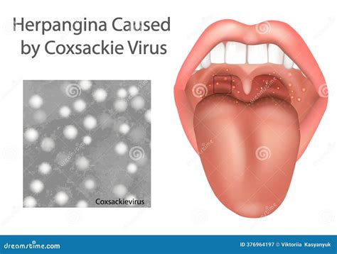 Herpangina Caused By Coxsackievirus. Medical Illustration Of ...