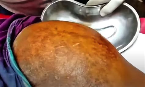 Image result for Painful Giant Abscess Exploding