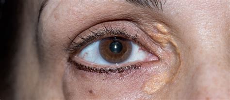 Cholesterol Plaques Under Eyes at Charli Light blog