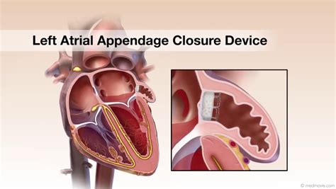 Left Atrial Appendage Closure