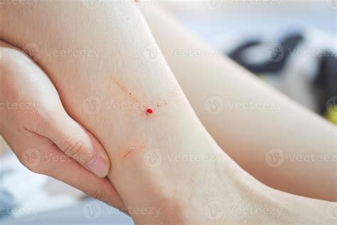 Cat Bite