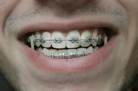 The Fascinating History Of Braces: When Were Braces Invented ...