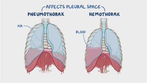 Hemothorax Vs Pneumothorax Hemothorax: Causes, Symptoms, Treatment And
