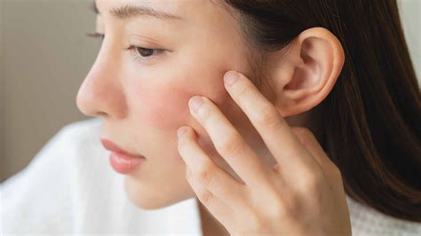 How to Treat Chemical Burn on Face: Expert Tips & Tricks