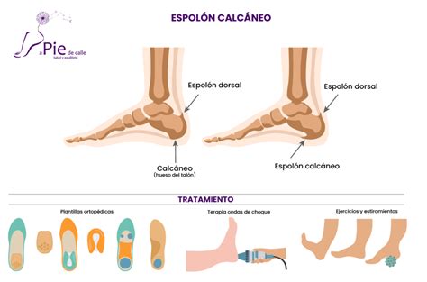 Espolón calcáneo: prevención y tratamiento
