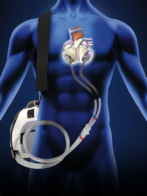 Artificial Heart