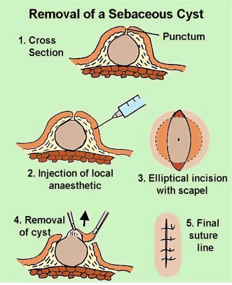 Image result for Sebaceous Cyst Removal Procedure
