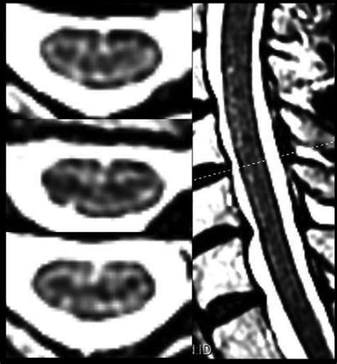 Fluid-Signal Structures in the Cervical Spinal Cord on MRI: Anterior ...