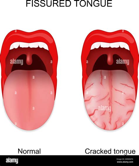 Fissured tongue. Healthy and cracked tongue. Oral cavity anomalies. Vector illustration Stock ...