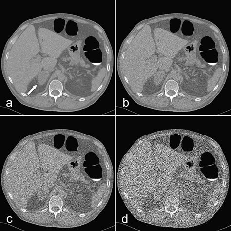 Colon distension and scan protocol for CT-colonography: An overview - European Journal of Radiology