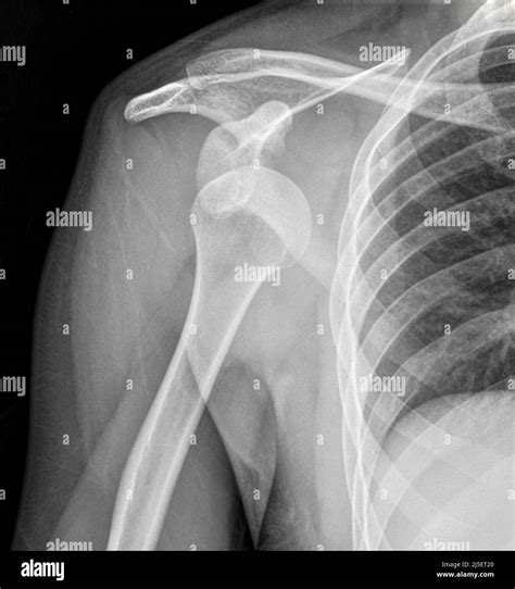 Dislocated right shoulder, X-ray Stock Photo - Alamy