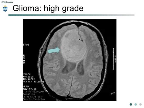 PPT - Pathology of CNS Tumors PowerPoint Presentation, free download - ID:8201837
