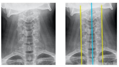 What Does A Normal Cervical Spine X Ray Look Like In Taiwan - Infoupdate.org