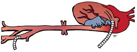 Image result for Left Thoracotomy