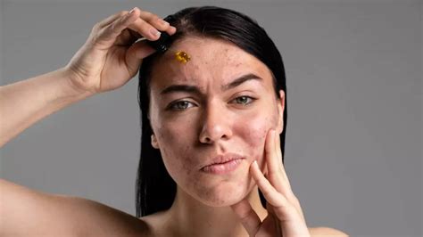 How to Get Rid of Acne Marks Without Harsh Treatments
