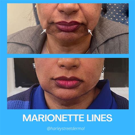 Marionette Lines Treatment in London | Harley Street Dermal