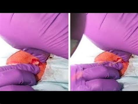 Image result for Abscessed Cysts Exploding