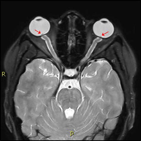 A High-Pressure Situation: Idiopathic Intracranial Hypertension Diagnosis and Treatments ...