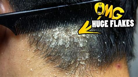 psoriasis flakes
