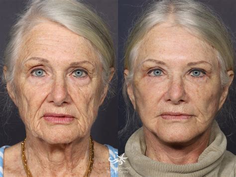 T-Z Plasty, Neck Lift & Rejuvenation in San Diego, CA | La Jolla ...