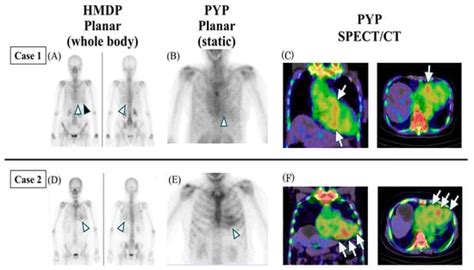 Incidental Cardiac Uptake on 99mTc-HMDP Bone Scintigraphy in Oncology ...