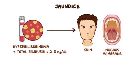 Approach to jaundice (conjugated hyperbilirubinemia): Clinical sciences ...