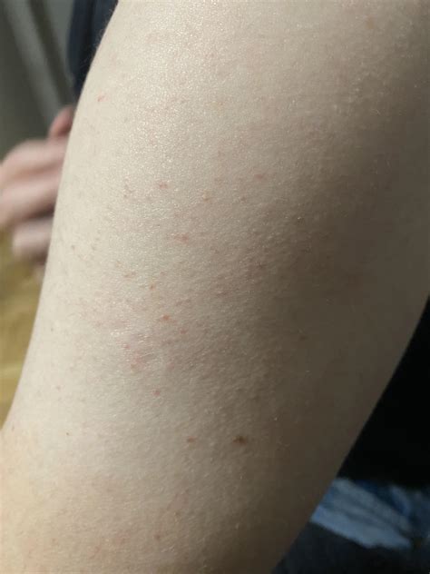 [Routine Help] bumpy skin on arms (a bit red and some look like pimples) : r/SkincareAddiction