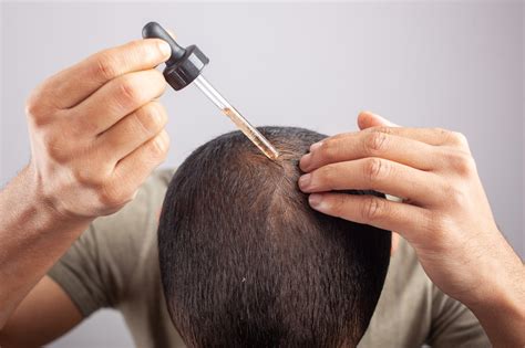 Beyond Scalps: Surprising Other Uses Of Minoxidil Explained