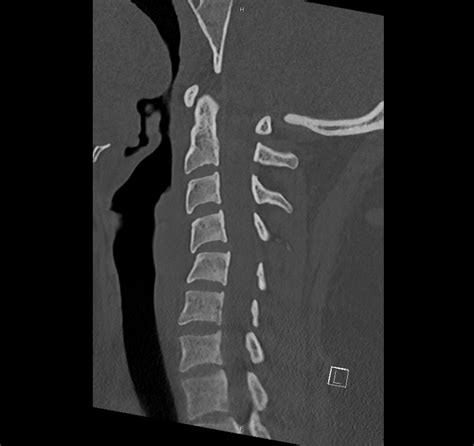 Differential Diagnosis of Infographic: CT Cervical Spine Interpretation