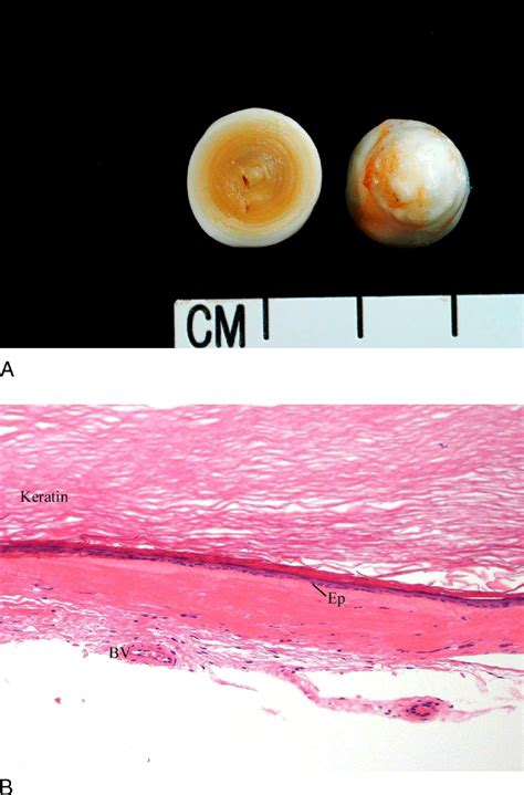 Epidermoid Cyst of the Testicle - Urology