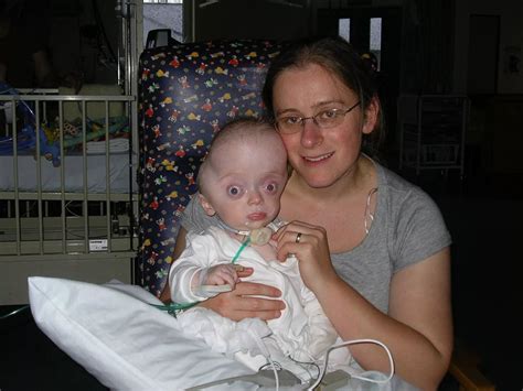 Thomas Pearce, who was born with the rare Pfeiffer syndrome - Wales Online