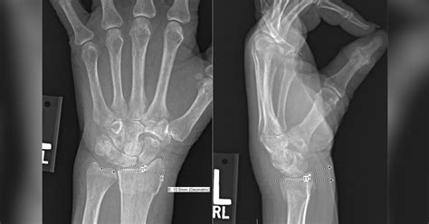 Radius Fracture 的图像结果