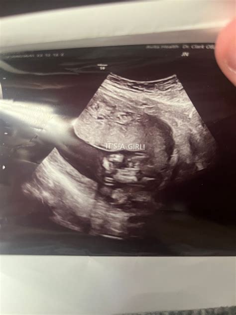 16 week pregnant ultrasound | BabyCenter