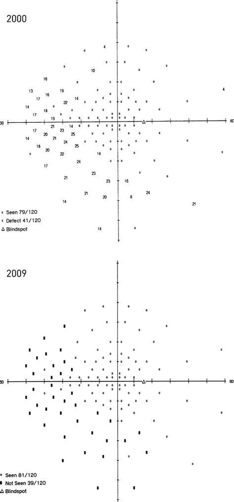 Image result for Peripheral Visual Field Defect