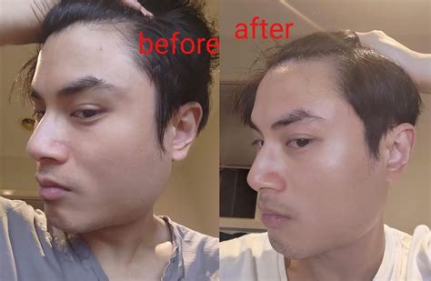 3 months result of Tretinoin after using retinol : r/tretinoin
