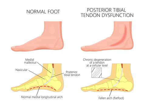 Running Foot Pain Tendonitis at John Verran blog