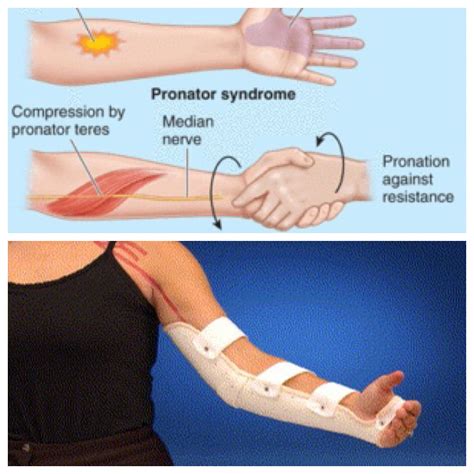Pronator syndrome: median nerve entrapment between pronator muscles. Splint in 90 degree elbow ...