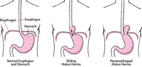 Hiatus Hernia - Hiatus Hernia - MSD Manual Professional Edition