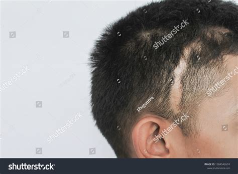 Scars On Head Scars Caused By Stock Photo 1584542674 | Shutterstock
