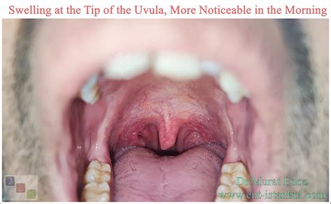 Your "Uvula" Can Tell You a Lot About Whether You Have Snoring and ...