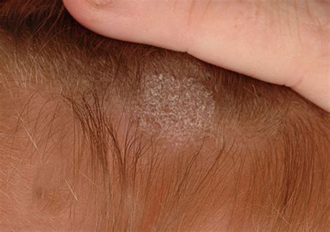 儿童头皮真菌感染图片和症状治疗