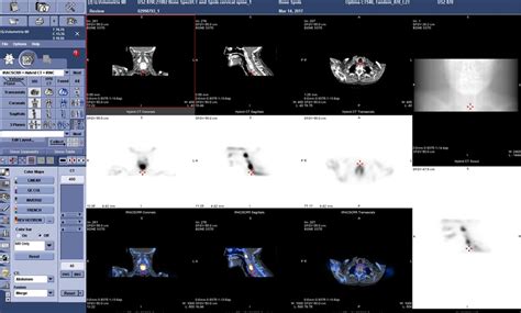 NM CT 870 CZT | GE HealthCare (India)